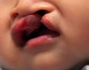 Seek counselling to prevent cleft lips in babies, expert urges parents